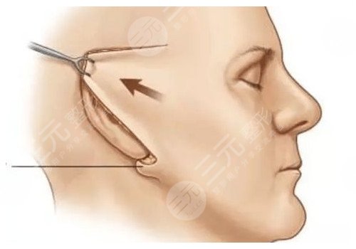 耳前皺紋多如果拉皮術(shù)會(huì)留疤嗎？