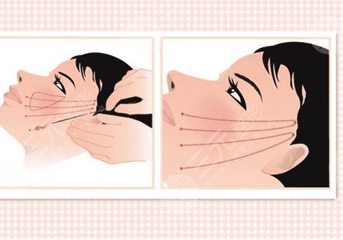 耳前皺紋多如果拉皮術(shù)會(huì)留疤嗎？