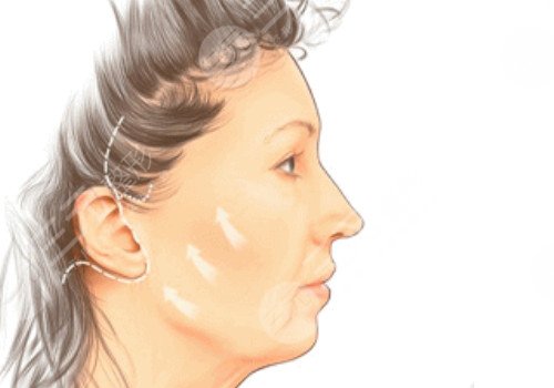 耳前皺紋多如果拉皮術(shù)會(huì)留疤嗎？