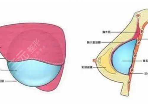 光面假體和毛面假體的優(yōu)缺點(diǎn)