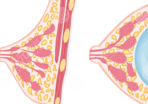 光面假體和毛面假體的優(yōu)缺點(diǎn)