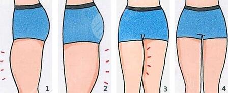 吸脂瘦腿