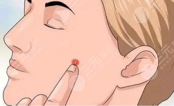 祛痘印期間吃什么好?