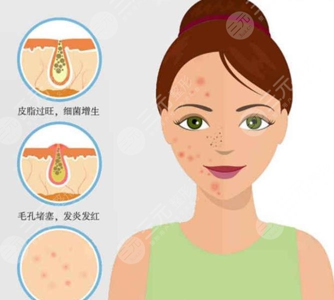 為什么會長閉合性粉刺