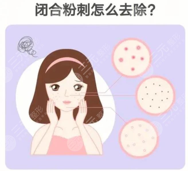 閉合性粉刺怎么清理