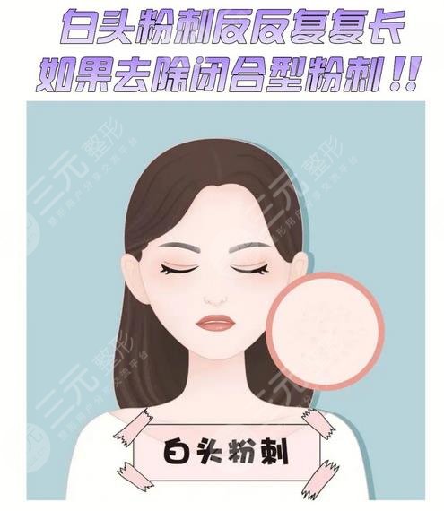閉合性粉刺怎么清理