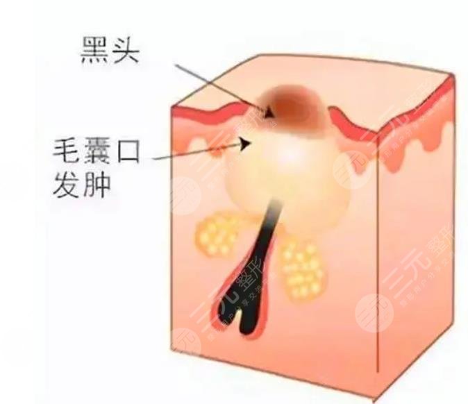 閉合性粉刺怎么清理