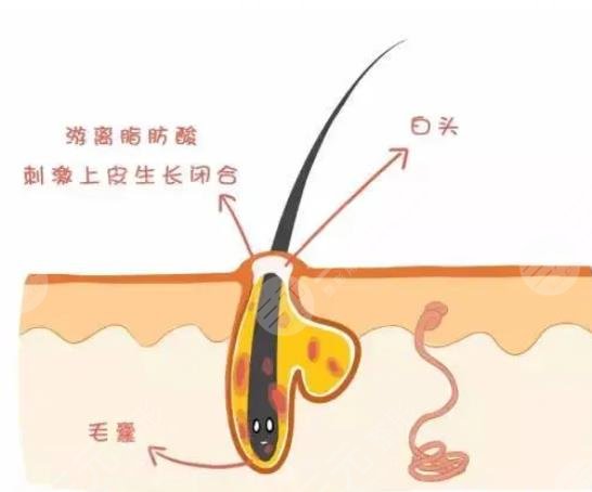 閉合性粉刺是怎么引起的