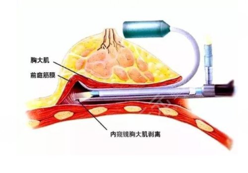 雙平面內(nèi)窺鏡隆胸幾天能不疼？