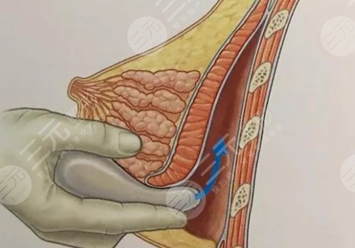 雙平面內(nèi)窺鏡隆胸幾天能不疼？