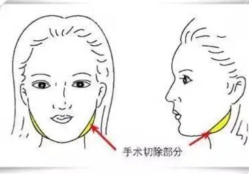 做臉部輪廓手術(shù)風(fēng)險(xiǎn)高嗎？