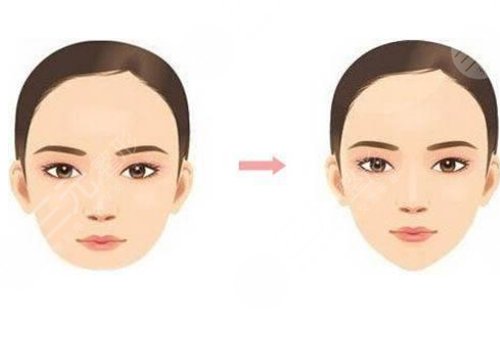 做臉部輪廓手術(shù)風(fēng)險(xiǎn)高嗎？