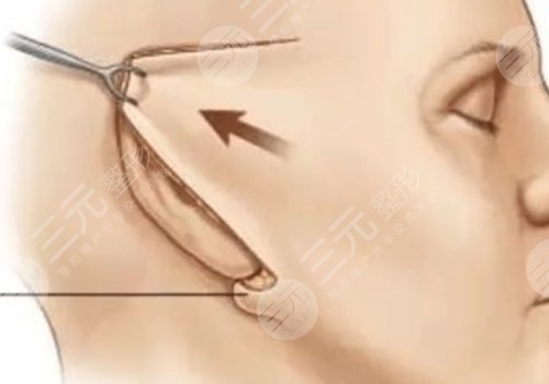 大拉皮手術15天是什么樣子？