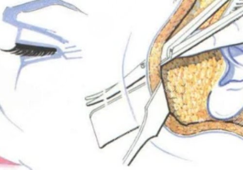 大拉皮手術15天是什么樣子？