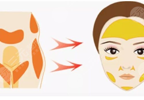 改良臉部輪廓做什么整形手術(shù)好？