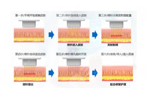 微針美塑和黃金微針的區(qū)別盤點