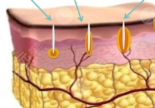 微針美塑和黃金微針的區(qū)別盤點