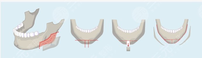 面部輪廓整形有什么后遺癥？