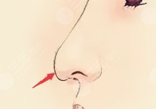 微調(diào)整形都有什么項(xiàng)目?