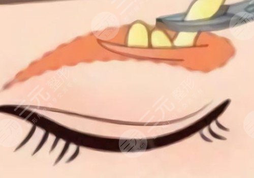 微調(diào)整形都有什么項(xiàng)目?