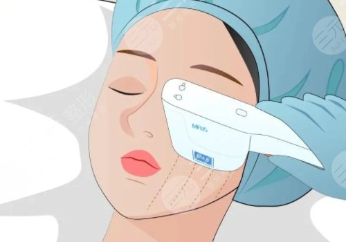 微調(diào)整形都有什么項(xiàng)目?