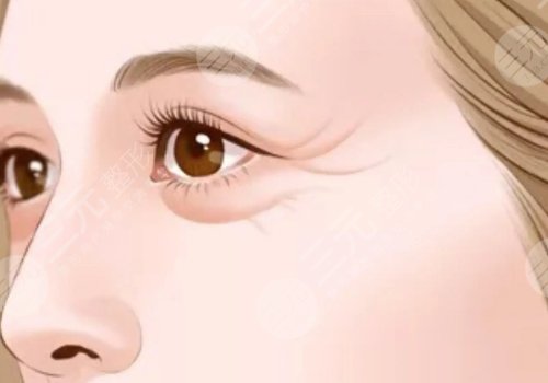 電波拉皮多久做一次合適？