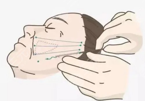 電波拉皮的功效與作用專業(yè)回答