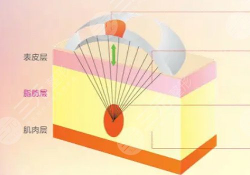 電波拉皮效果好嗎能維持多久？