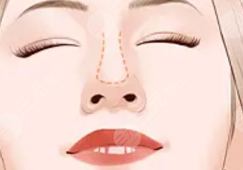 貴陽美萊做鼻子怎么樣？