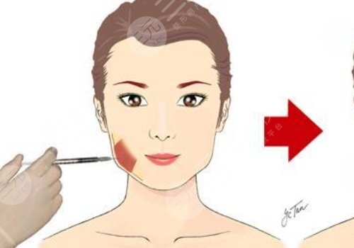 臉部微調(diào)大概多少錢？包括哪些項(xiàng)目？