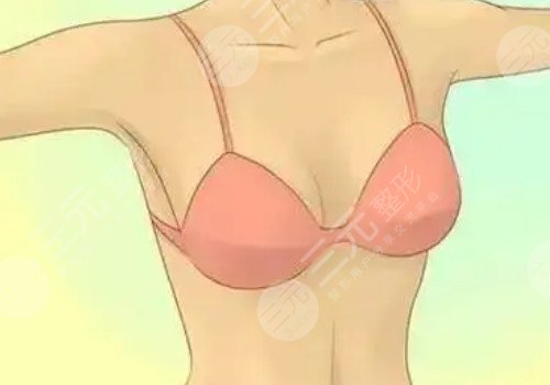 胸修復需要更換假體嗎？