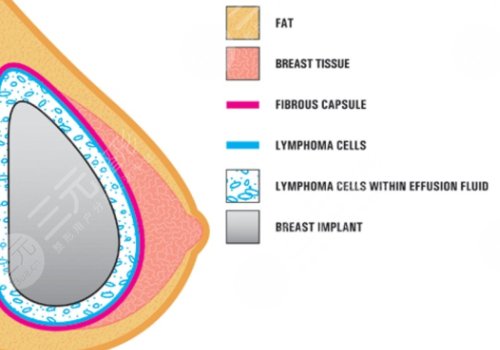 水滴形假體隆胸多少錢？