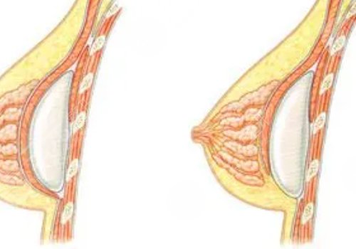 水滴形假體隆胸多少錢？