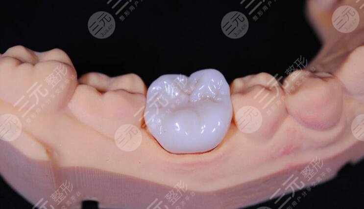 勁松口腔根管緩解案例