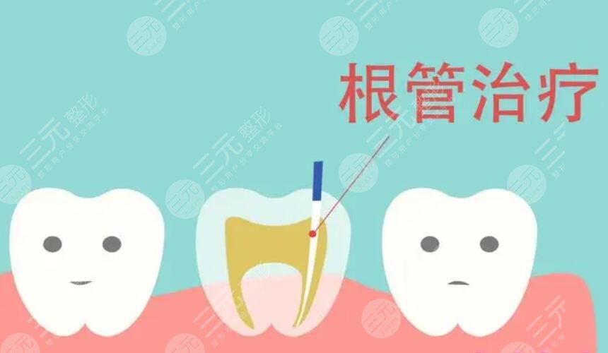 勁松口腔根管緩解案例