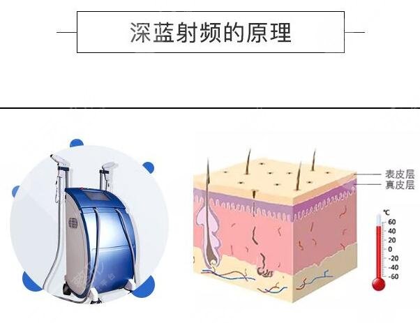 深藍(lán)射頻原理是什么?