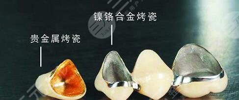 烤瓷牙修復(fù)能美白牙齒嗎?