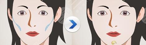 面部填充大概費用?