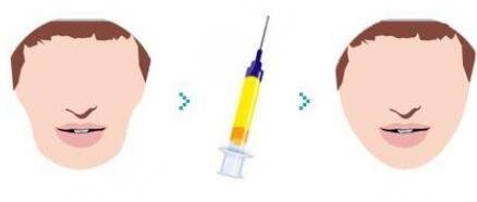 面部填充多久消腫?