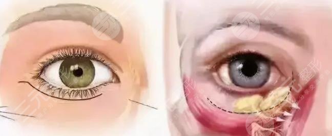 外切眼袋恢復過程圖