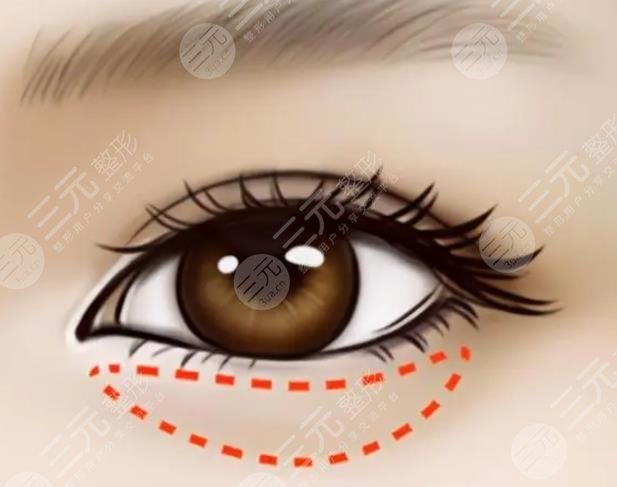 外切眼袋恢復過程圖