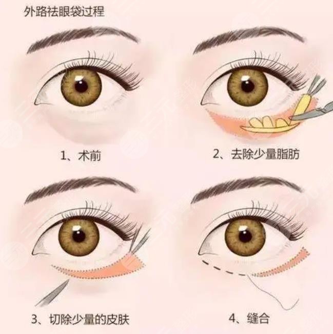 外切眼袋恢復過程圖