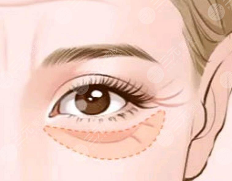 外切眼袋恢復過程圖