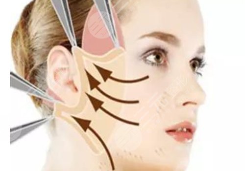 筋膜復(fù)位術(shù)能保持多久?