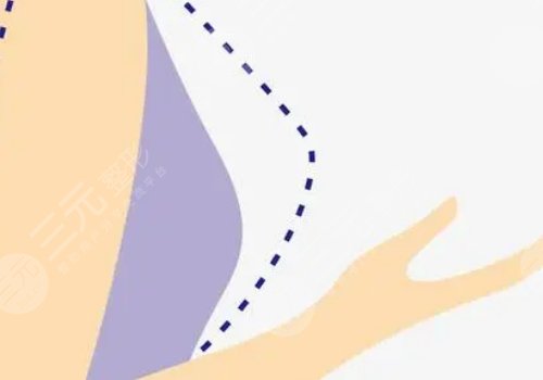 威寧之星假體隆胸價格是多少？