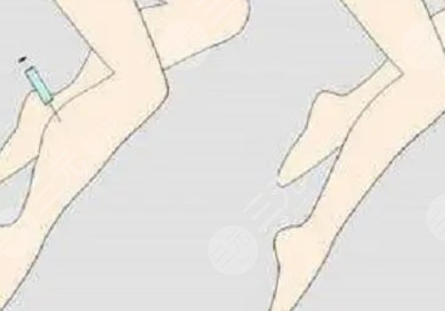 注射瘦腿會反彈嗎？