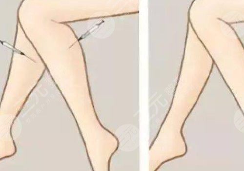 注射瘦腿會反彈嗎？