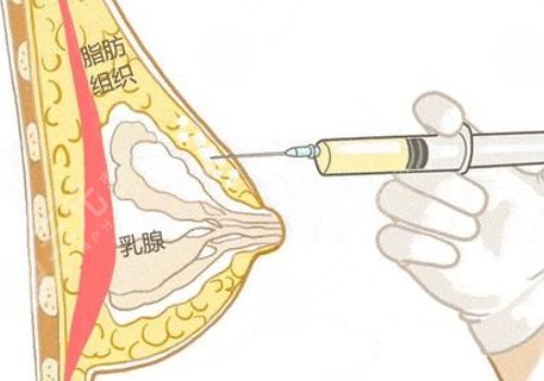 注射玻尿酸豐胸是什么?