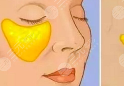 臉部填充用什么填充好？