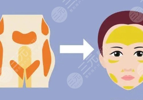 臉部填充用什么填充好？